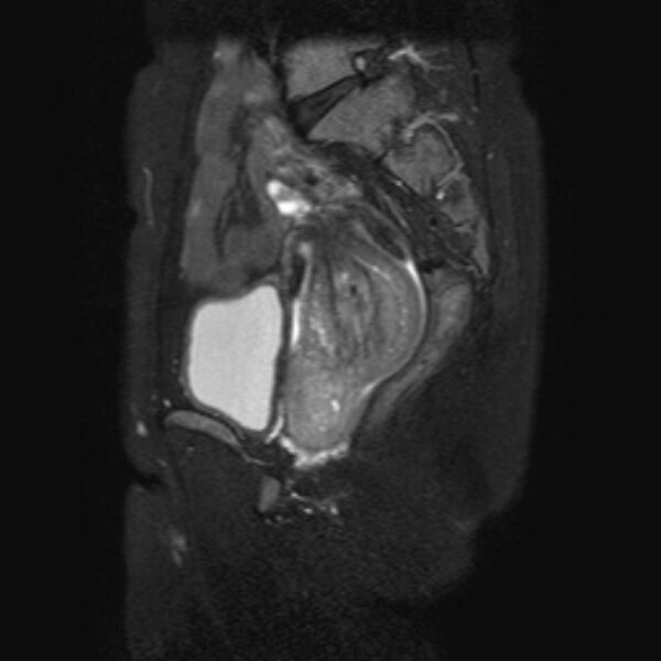 File:Non-puerperal uterine inversion (Radiopaedia 78343-90983 Sagittal T2 fat sat 11).jpg