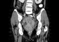 Non-puerperal uterine inversion (Radiopaedia 78343-91094 B 29).jpg
