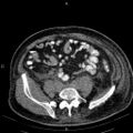 Non Hodgkin lymphoma in a patient with ankylosing spondylitis (Radiopaedia 84323-99621 Axial non-contrast 47).jpg