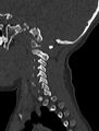 Normal CT cervical spine - pediatric (Radiopaedia 52549-58462 Sagittal bone window 162).jpg