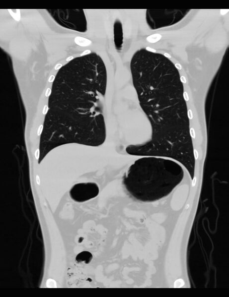 File:Normal CT virtual gastroscopy (Radiopaedia 29960-30501 F 10).jpg