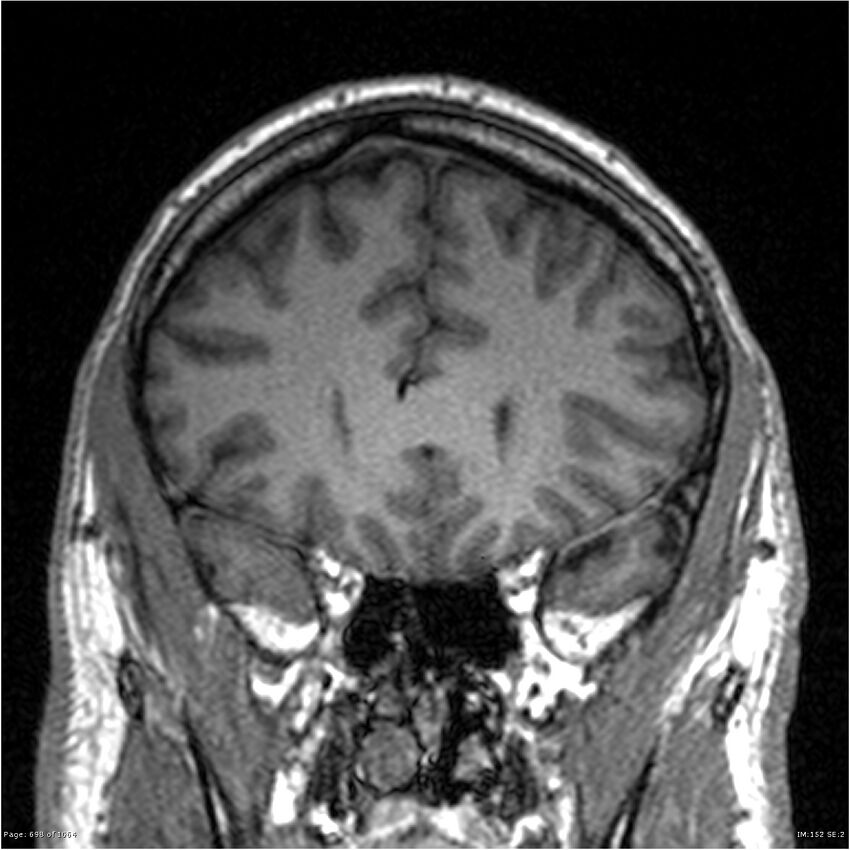Normal brain MRI (non-focal epilepsy protocol) (Radiopaedia 38571-40700 Coronal T1 75).jpg