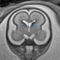 Normal brain fetal MRI - 22 weeks (Radiopaedia 50623-56604 Ganglionic eminences 1).jpg