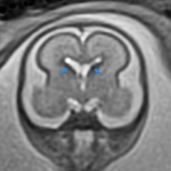 File:Normal brain fetal MRI - 22 weeks (Radiopaedia 50623-56604 Ganglionic eminences 1).jpg
