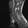 Normal cervical spine MRI (Radiopaedia 38418-40496 Sagittal T1 10).jpg