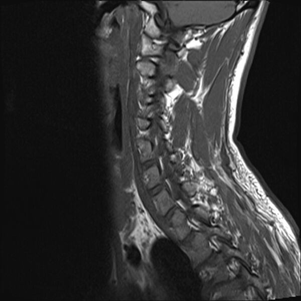 File:Normal cervical spine MRI (Radiopaedia 38418-40496 Sagittal T1 10).jpg