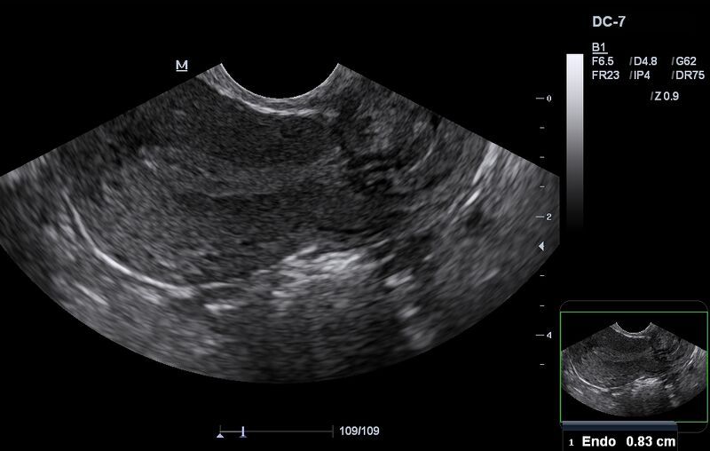 File:Normal early proliferative endometrium (Radiopaedia 30612).JPG