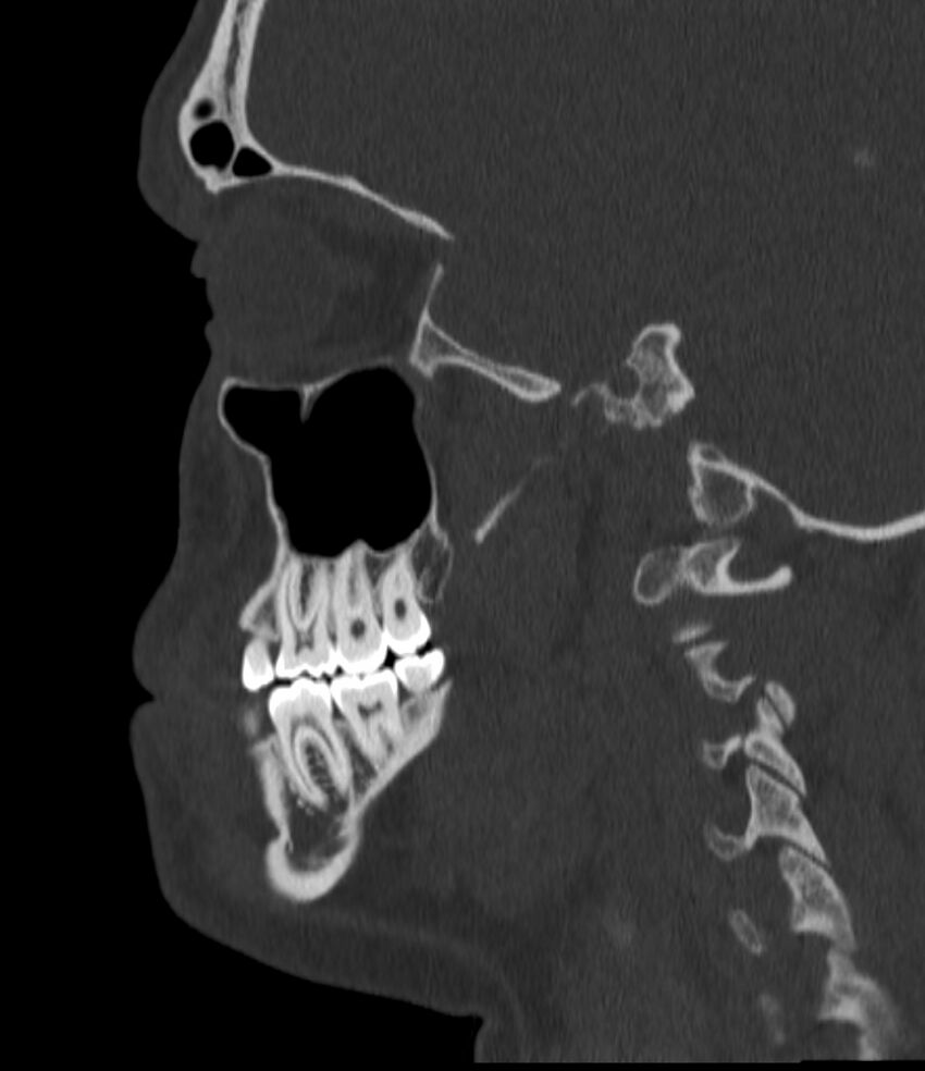 Normal facial bone CT (Radiopaedia 88742-105476 Sagittal bone window 112).jpg