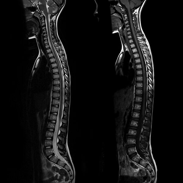 File:Normal full length spine MRI (Radiopaedia 8245).jpg