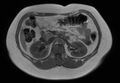 Normal liver MRI with Gadolinium (Radiopaedia 58913-66163 Axial T1 in-phase 14).jpg