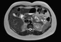 Normal liver MRI with Gadolinium (Radiopaedia 58913-66163 Axial T2 19).jpg