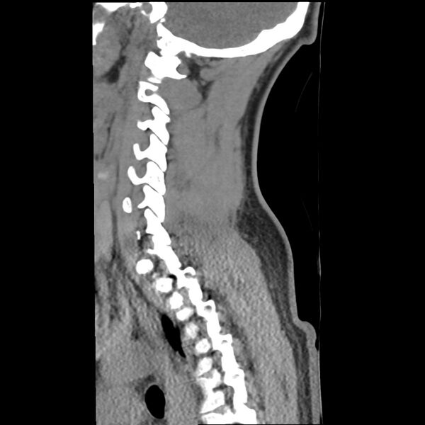 File:Normal trauma spine imaging (Radiopaedia 31753-32686 A 31).jpg