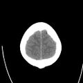 Obstructive hydrocephalus (Radiopaedia 30453-31119 Axial non-contrast 25).jpg