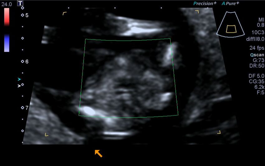1st trimester nuchal-morphology ultrasound (Radiopaedia 44706-48477 Heart views cine with colour 188).jpg