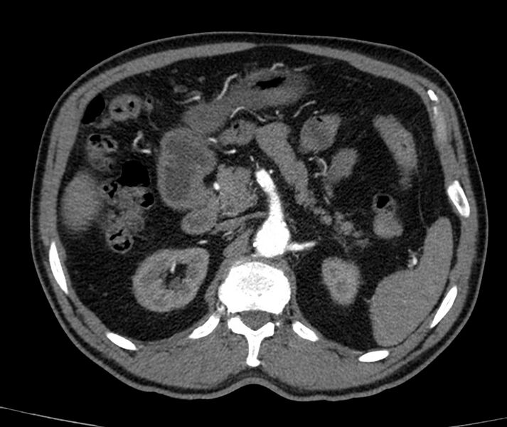 File:Abdominal aortic aneurysm (Radiopaedia 22421-22458 C+ arterial phase 22).jpg