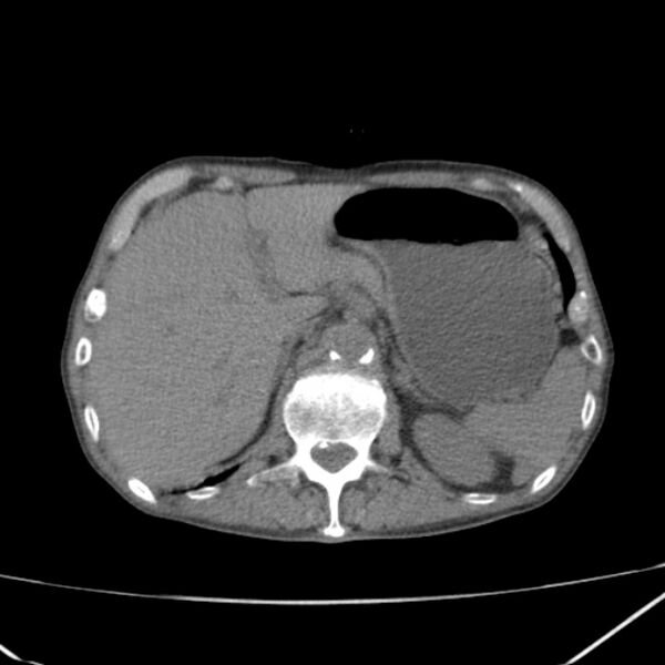 File:Abdominal aortic aneurysm (Radiopaedia 23703-23856 Axial non-contrast 13).jpg