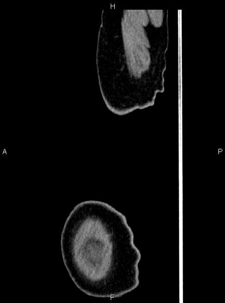 File:Abdominal aortic aneurysm (Radiopaedia 83094-97462 Sagittal renal cortical phase 129).jpg