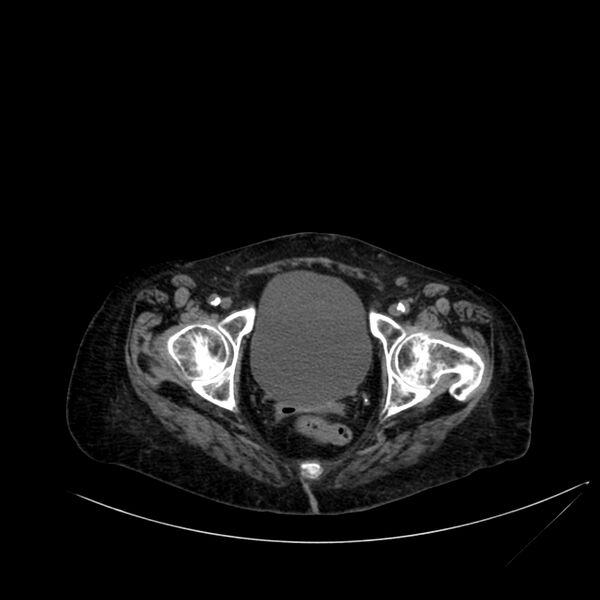 File:Abdominal aortic aneurysm - impending rupture (Radiopaedia 19233-19246 Axial non-contrast 119).jpg