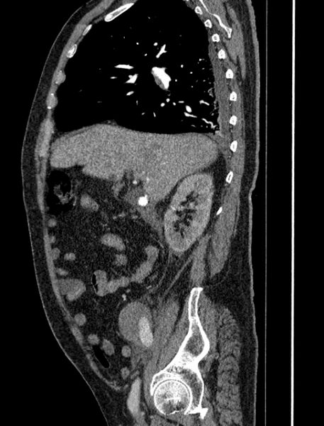 File:Abdominal aortic aneurysm rupture (Radiopaedia 54179-60362 Sagittal C+ arterial phase 12).jpg