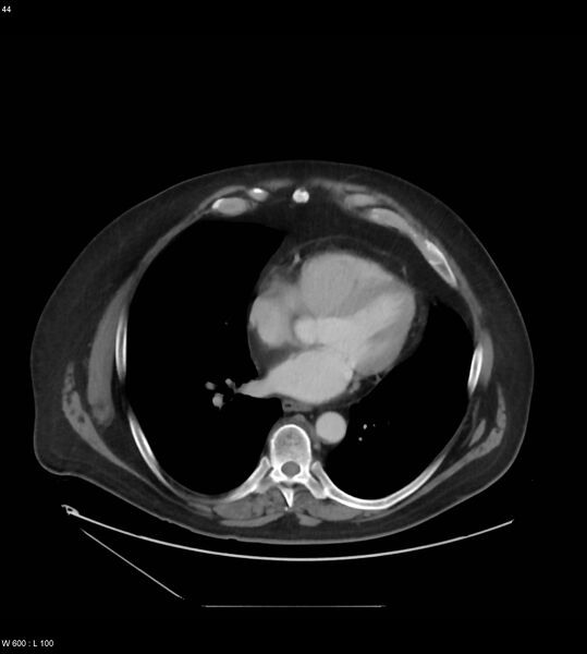 File:Abdominal aortic aneurysm with intramural hematoma then rupture (Radiopaedia 50278-55631 Axial C+ arterial phase 35).jpg