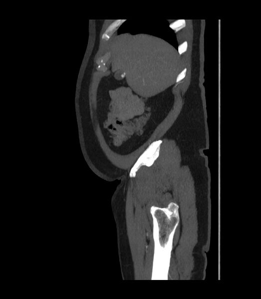 File:Abdominal aortic aneurysm with thrombus fissuration (Radiopaedia 46218-50618 Sagittal C+ arterial phase 7).jpg