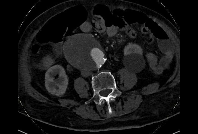 File:Abdominal aortic aneurysm with thrombus fissuration (Radiopaedia 73192-83919 Axial C+ arterial phase 123).jpg