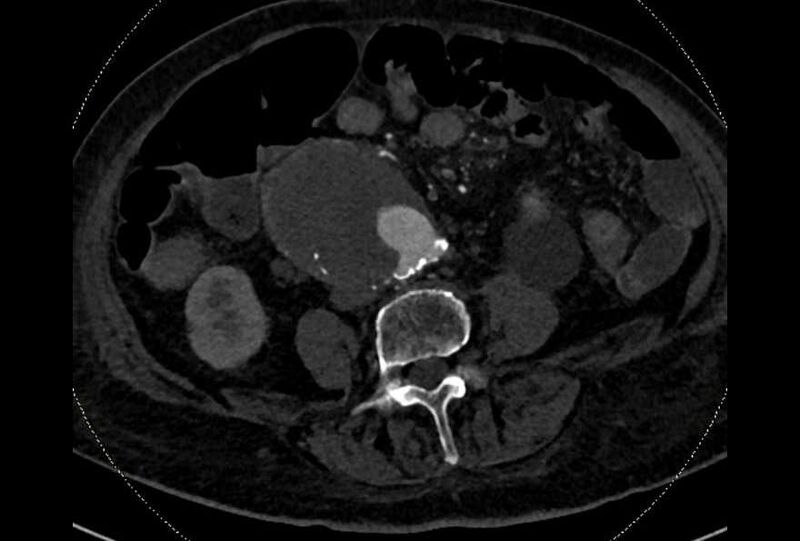 File:Abdominal aortic aneurysm with thrombus fissuration (Radiopaedia 73192-83919 Axial C+ arterial phase 128).jpg