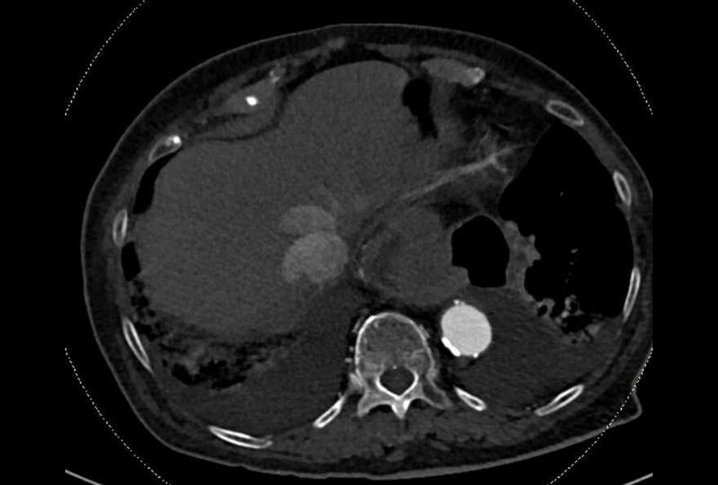 File:Abdominal aortic aneurysm with thrombus fissuration (Radiopaedia 73192-83919 Axial C+ arterial phase 3).jpg