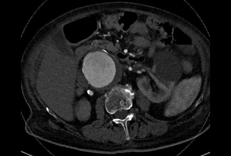 File:Abdominal aortic aneurysm with thrombus fissuration (Radiopaedia 73192-83919 Axial C+ arterial phase 63).jpg