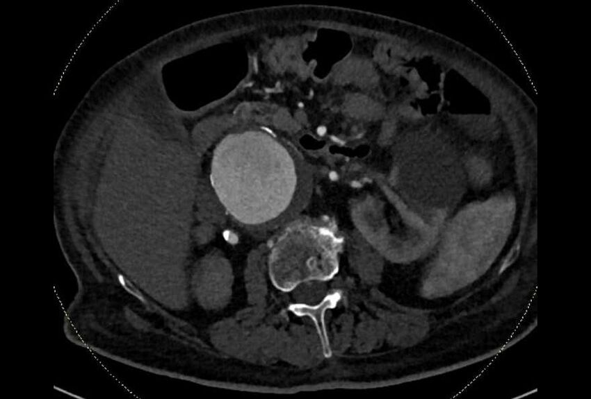 Abdominal aortic aneurysm with thrombus fissuration (Radiopaedia 73192-83919 Axial C+ arterial phase 63).jpg