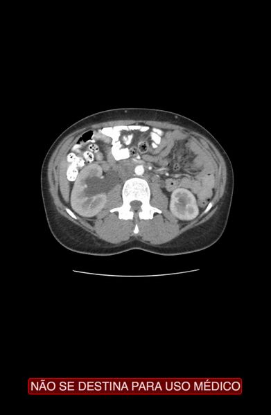 File:Abdominal desmoid tumor (Radiopaedia 44024-47540 Axial C+ arterial phase 10).jpg