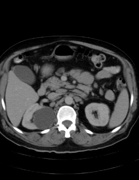 File:Abdominal lymphoma - with sandwich sign (Radiopaedia 53486-59492 Axial C+ portal venous phase 18).jpg