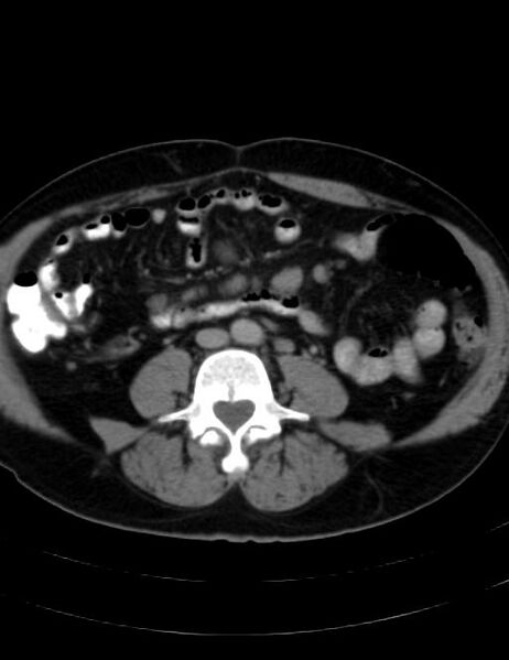 File:Abdominal lymphoma - with sandwich sign (Radiopaedia 53486-59492 Axial C+ portal venous phase 30).jpg