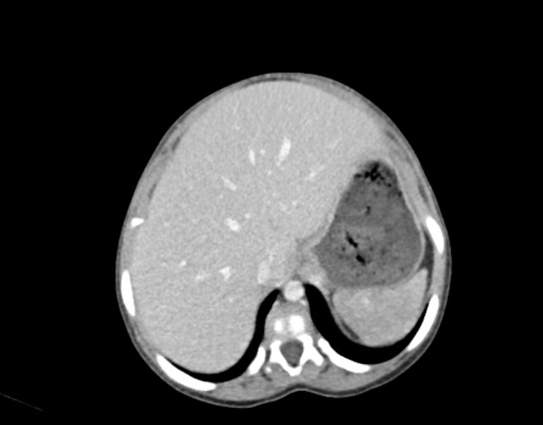 File:Abdominal premesenteric cystic lymphangioma (Radiopaedia 82995-97350 Axial C+ portal venous phase 7).jpg