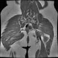 Abdominal wall endometriosis (Radiopaedia 83702-98847 Coronal T1 16).jpg