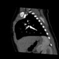 Aberrant left pulmonary artery (pulmonary sling) (Radiopaedia 42323-45435 Sagittal C+ arterial phase 39).jpg