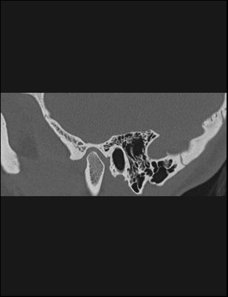 File:Aberrant right internal carotid artery (Radiopaedia 65191-74198 Sagittal non-contrast 31).jpg
