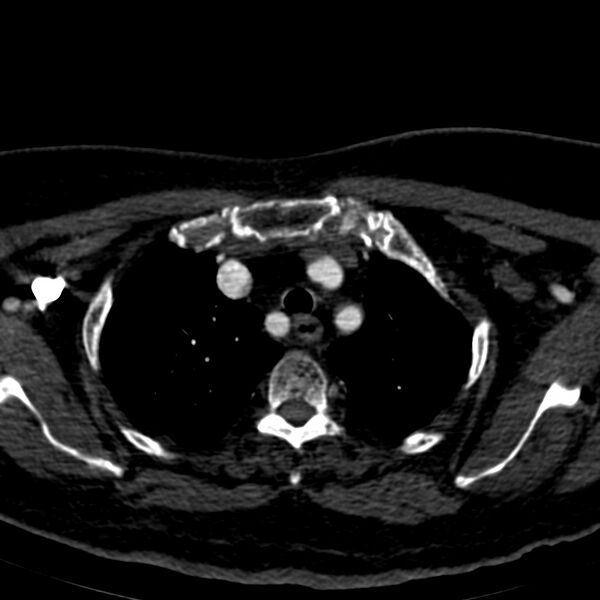 File:Aberrant right subclavian artery (Radiopaedia 19283-19294 Axial C+ arterial phase 16).jpg