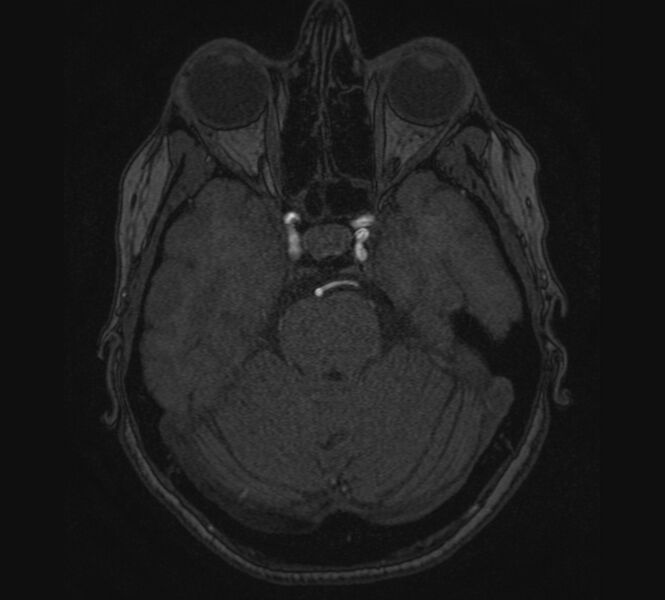 File:Accessory middle cerebral artery and ICA aneurysm (Radiopaedia 22656-22674 MRA 28).jpg