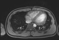 Active right ventricular cardiac sarcoidosis (Radiopaedia 55596-62100 Axial Post contrast Dixon 54).jpg