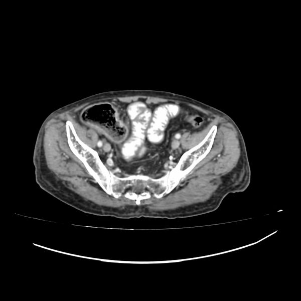 File:Acute-on-chronic Crohn disease with enteroenteric fistula (Radiopaedia 66686-75987 B 59).jpg