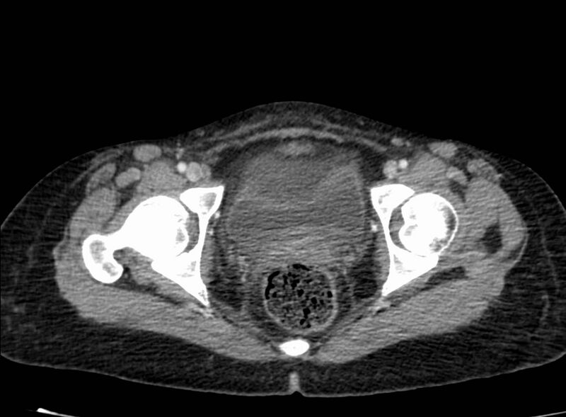 File:Acute Budd-Chiari syndrome (Radiopaedia 60858-68638 Axial C+ portal venous phase 284).jpg