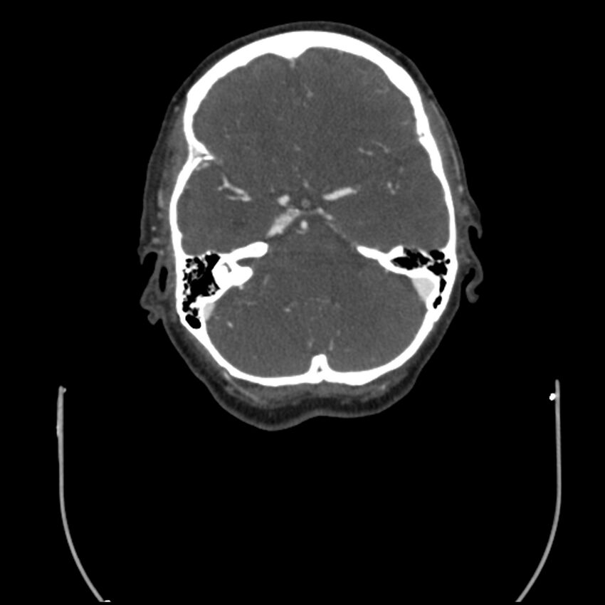 Acute M1 occlusion with ischemic penumbra (CT perfusion) (Radiopaedia 71897-82344 Axial C+ arterial phase thins 100).jpg