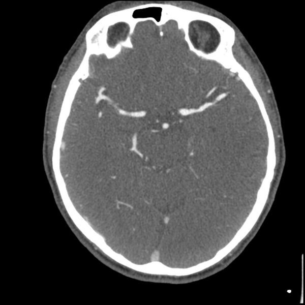 File:Acute P1 occlusion with PCA ischemia penumbra (CT perfusion) (Radiopaedia 72084-82587 Axial C+ arterial thins 37).jpg