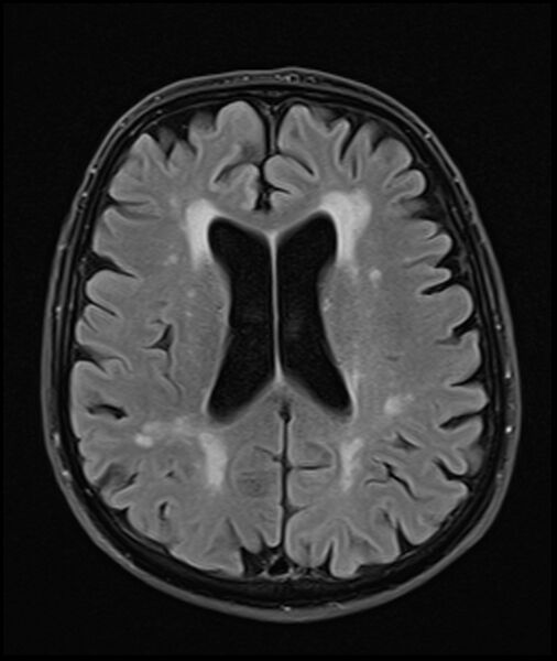 File:Acute P1 occlusion with PCA ischemia penumbra (CT perfusion) (Radiopaedia 72084-82590 Axial FLAIR 23).jpg
