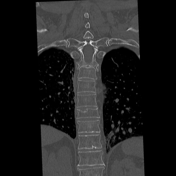 File:Acute and chronic vertebral compression fractures (Radiopaedia 31608-32494 Coronal bone window 28).jpg