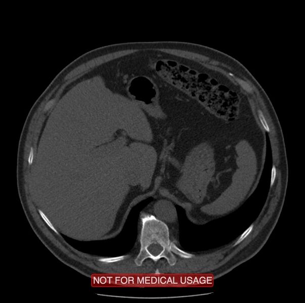 File:Acute aortic dissection - Stanford type A (Radiopaedia 40661-43285 Axial non-contrast 74).jpg