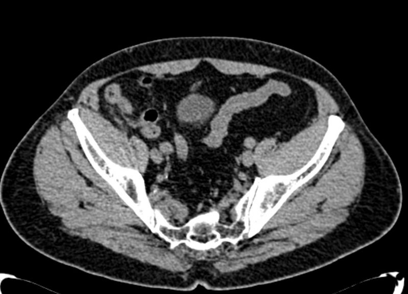 File:Acute appendicitis (Radiopaedia 13030-13091 Axial non-contrast 67).jpg