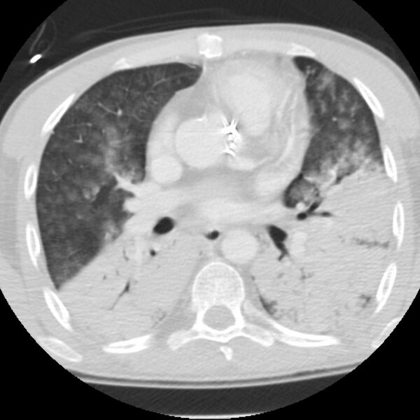 File:Acute diffuse alveolar hemorrhage (Radiopaedia 41323-44158 Axial lung window 30).jpg
