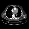 Acute heart failure (CT) (Radiopaedia 79835-93075 Axial C+ arterial phase 23).jpg